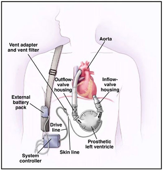 7c814-lvad